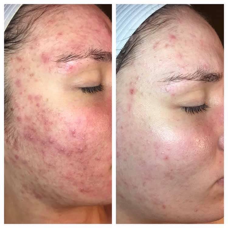 Herbal Facial