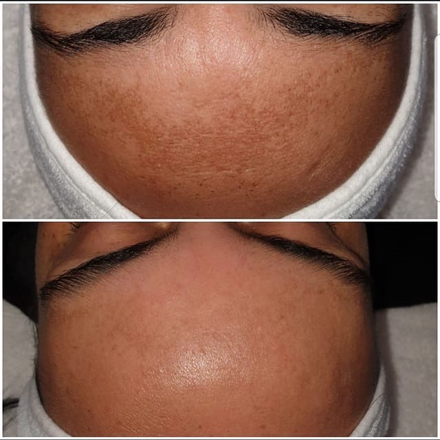 SQT Bio Microneedling