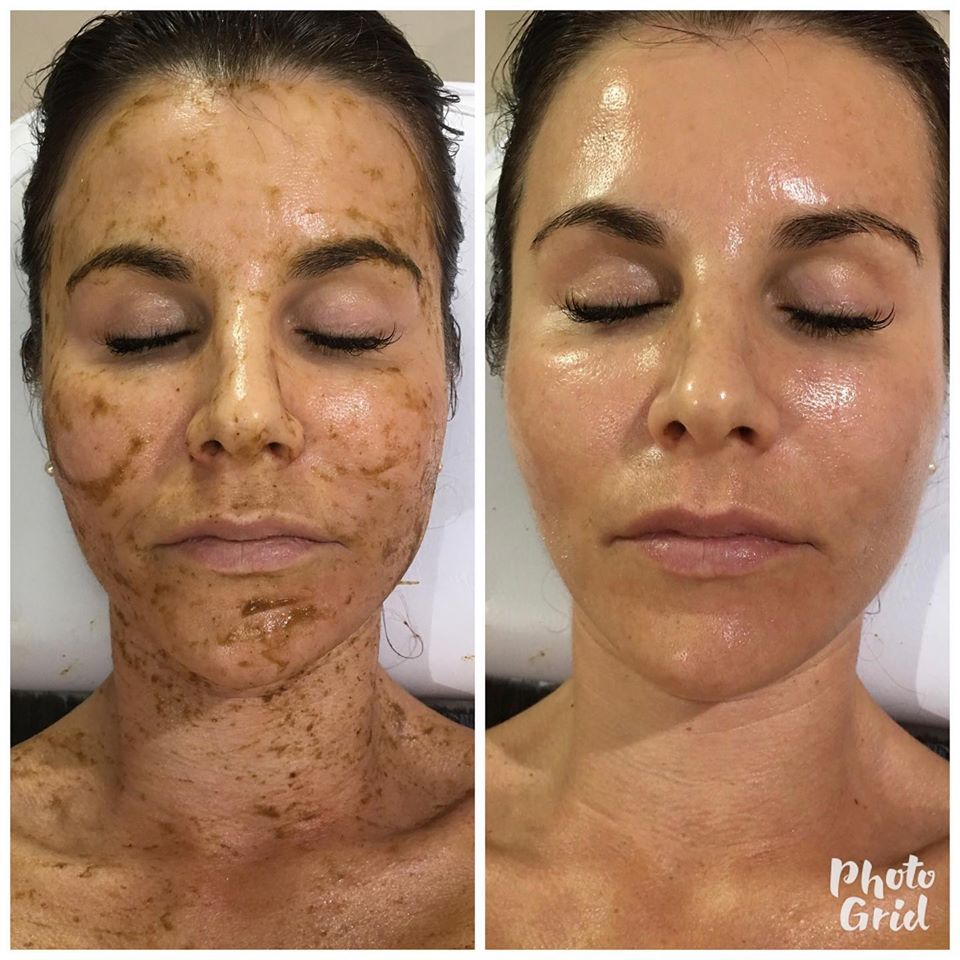 SQT Bio Microneedling