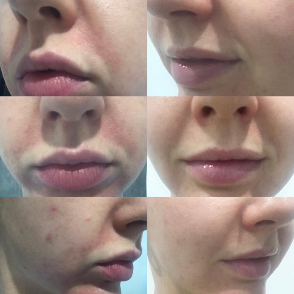 SQT Bio Microneedling